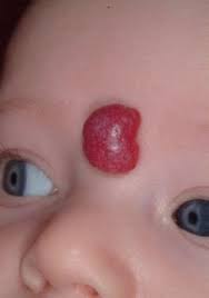 Cherry angiomas are red moles on your skin which contain an abnormal amount of blood vessels. Infantile Hemangiomas And Phace Syndrome Children S Wisconsin