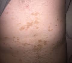 Braune Flecken Am Bauch Hautkrankheit Gesundheit Und Medizin Gesundheit Korper