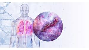 Image result for Legionella