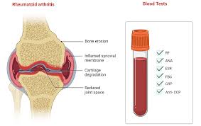 Image result for Rheumatoid Factor