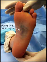 Petechiae are tiny purple or red spots that look like a bruise when clustered together. Midfoot Trauma Lisfranc Injuries Orthopaedia