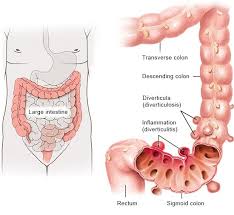 Diverticular Disease And Diverticulitis Informedhealth Org