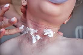 Image result for Atopic eczema atopic dermatitis