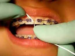 Pin On Gum Disease Treatment