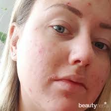 Jun 13, 2021 · selanjutnya, pilih tabir surya berdasarkan seberapa berminyak atau kering kulit anda. Panduan Pemula 5 Ciri Ciri Kulit Kombinasi