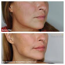 AMAZING RESULTS after just one “Make me Javan (young)” facial  treatment🤩🙌🏼. ✳️I always encourage my clients to not only get  Botox/fillers but also get facial treatments to improve skin quality and  stimulate