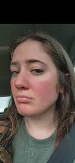 Warning .. a little graphic. I get this rash