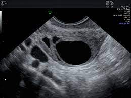 It is the leading cause of death from gynaecological cancer3 the ultrasound score is the number of the following findings on scan: Simple Vs Complex Ovarian Cysts The Link To Ovarian Cancer Empowered Women S Health