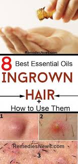 To reduce the risk of cysts developing from an ingrown hair, people can try the following: Pin On Keto Diet Plan For Weight Loss