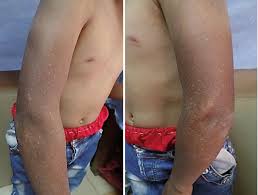 Image result for Diffuse Hyperpigmentation