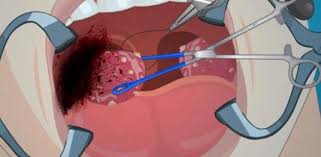 Keradangan dan kemerahan tisu tonsil. Tanda Tanda Tonsil Sakit Tekak Seperti Ini Tak Semua Perlu Lakukan Pembedahan Buang