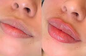 Dos and don'ts after having cosmetic fillers. Needle Less Lip Filler Touch Up Session