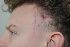 Basal cell carcinoma tumors have a variety of appearances from white or … Sunderland Skin Cancer Battler Whose Life Was Saved By Bad Haircut Gets More Good News Sunderland Echo