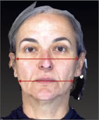 Previsão de variáveis e prevenção de resultados subótimos no  rejuvenescimento cirúrgico de face e pescoço: avaliação pré-operatória  sistemática com exame físico e ecografia