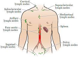 Common areas where you might notice swollen lymph nodes. Radiation Therapy To Your Lymph Nodes Memorial Sloan Kettering Cancer Center