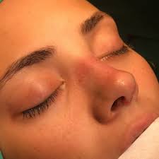 Pin By Rina On Make Up In 2020 Rhinoplasty Nose Jobs Nose Plastic Surgery Nose Surgery Rhinoplasty