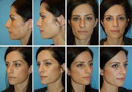 Maybe you would like to learn more about one of these? Virtual Rhinoplasty Tool Face Touch Up Nose Job Simulator