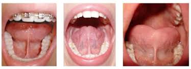 Image result for Ankyloglossia