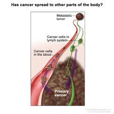 If cancer has reached these lymph nodes, it may have also spread to other lymph nodes, the bones, or other organs. Melanoma Cells That Pass Through Lymph More Likely To Spread National Cancer Institute