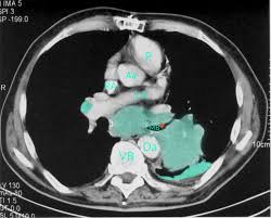 If the cancer spreads ( metastasizes) beyond the lungs to other body parts and organs, other symptoms may arise. Lung Cancer Knowledge Amboss
