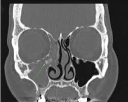 If you have nasal polyps and chronic sinusitis, your doctor may give you an injection of a medication called dupilumab (dupixent) to treat your condition. Three Dimensional Reconstruction Of Noncontrast Computed Tomography Download Scientific Diagram