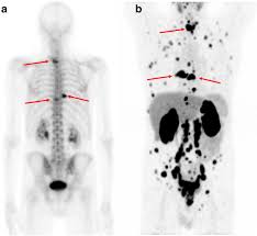 The spread may be very rapid, as in this case, where it took only eight months since … Added Value Of 68ga Psma Pet Ct For The Detection Of Bone Metastases In Patients With Newly Diagnosed Prostate Cancer And A Previous 99mtc Bone Scintigraphy Ejnmmi Research Full Text