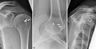 Bigliani, with 618 highly influential citations and 296 scientific research papers. Surgical Reconstruction Of The Anterolateral Acromion With A Tricortical Iliac Crest Bone Graft After Extensive Acromioplasty Springerlink
