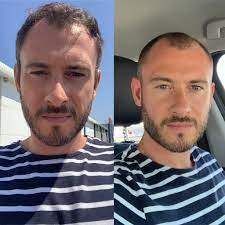Buzz Cut With Receding Hairline Reddit Novocom Top