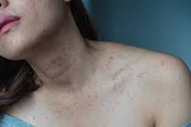 Image result for heat rash under breasts