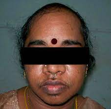 I know this sounds funny, but i bought a tiny trimmer finishing touch lighted hair remover from bed bath and beyond for $9.99 and i use it on my face, because i have sensitive skin too. Androgenic Alopecia And Excess Facial Hair This Photo Shows Growth Of Download Scientific Diagram