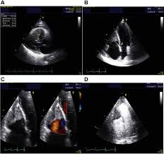 Myocarditis is the inflammation of the muscular tissue of the heart, which helps pump blood in and out of the rest of the body. Loeffler Endocarditis A Manifestation Of Hypereosinophilic Syndrome Case