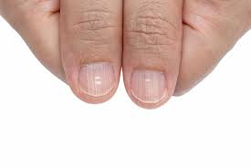 nail abnormalities causes symptoms and pictures