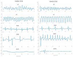 There is no clinically significant association between the conversion to a shockable rhythm and resuscitation outcomes in patients suffering from ohca. Sensors Free Full Text Fully Convolutional Deep Neural Networks With Optimized Hyperparameters For Detection Of Shockable And Non Shockable Rhythms