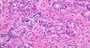 Later, under the influence of sertoli cells, the leydig cells develop (ge et al. Histopathologic Findings Of The Ovarian Sertoli Leydig Cell Tumor Download Scientific Diagram