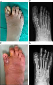 Image result for toe amputation