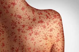 Image result for Measles