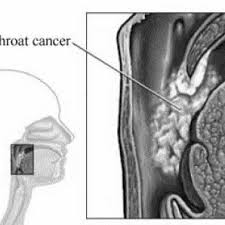 Learn the different symptoms also called: Throat Cancer Tumor Download Scientific Diagram