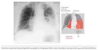 It is sometimes classified as atypical pneumonia. Een Patient Met Een Pneumonie Door Legionella Pneumophila Serogroep 3 Vastgesteld Door Pcr Nederlands Tijdschrift Voor Geneeskunde