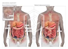 Female abdominal anatomy images female abdominal anatomy. Abdominal Adhesions High Impact Visual Litigation Strategies