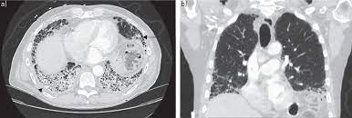 Rheumatoid Arthritis Associated Lung Disease European Respiratory Society