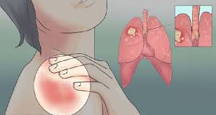 Lung cancer typically doesn't cause signs and symptoms in its earliest stages. 20 Early Warning Signs Of Lung Cancer That Women Should Never Ignore Quickrecipes