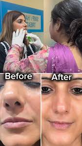 Dr. Amol Rathore Returns to Aesthetics by Shikha Sardana for Botox,  Fillers, and Threads