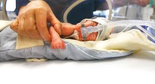 Ab wann ist das baby kein frühchen mehr: Fruhgeburt Als Syndrom Kranke Lunge Schwachelnder Iq