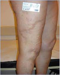 How To Prevent Complications And Side Effects From Sclerotherapy Of The Lower Limb Veins Servier Phlebolymphologyservier Phlebolymphology