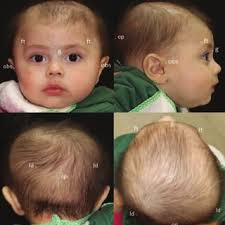 PDF) Treatment of Deformational Plagiocephaly With Physiotherapy