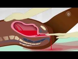 Image result for kutokwa damu wakati wa ujauzito
