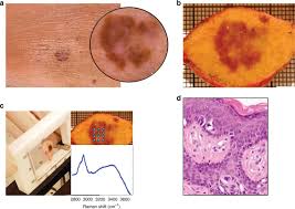 Learn about the academy's efforts to refocus its brand on education. Improving Clinical Diagnosis Of Early Stage Cutaneous Melanoma Based On Raman Spectroscopy British Journal Of Cancer