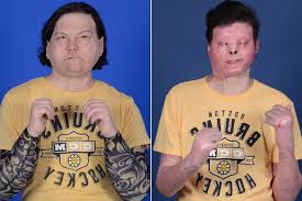 Joe dimeo received two new hands and a full face, including forehead, eyebrows, nose, eyelids, lips mr dimeo has received a face and double hand transplant and is determined to attain complete. Tc9hgwalusja M