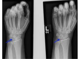 Image result for Lunate Dislocation