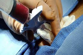 Il midollo osseo è costituito dalle cellule staminali, si presenta come sangue e si trova localizzato nelle parte più interna delle ossa (osso spugnoso). Donazione Midollo Osseo Emiliano Sottoscrive La Convenzione Con Admo Oltre Free Press Quotidiano Di Notizie Gratuite